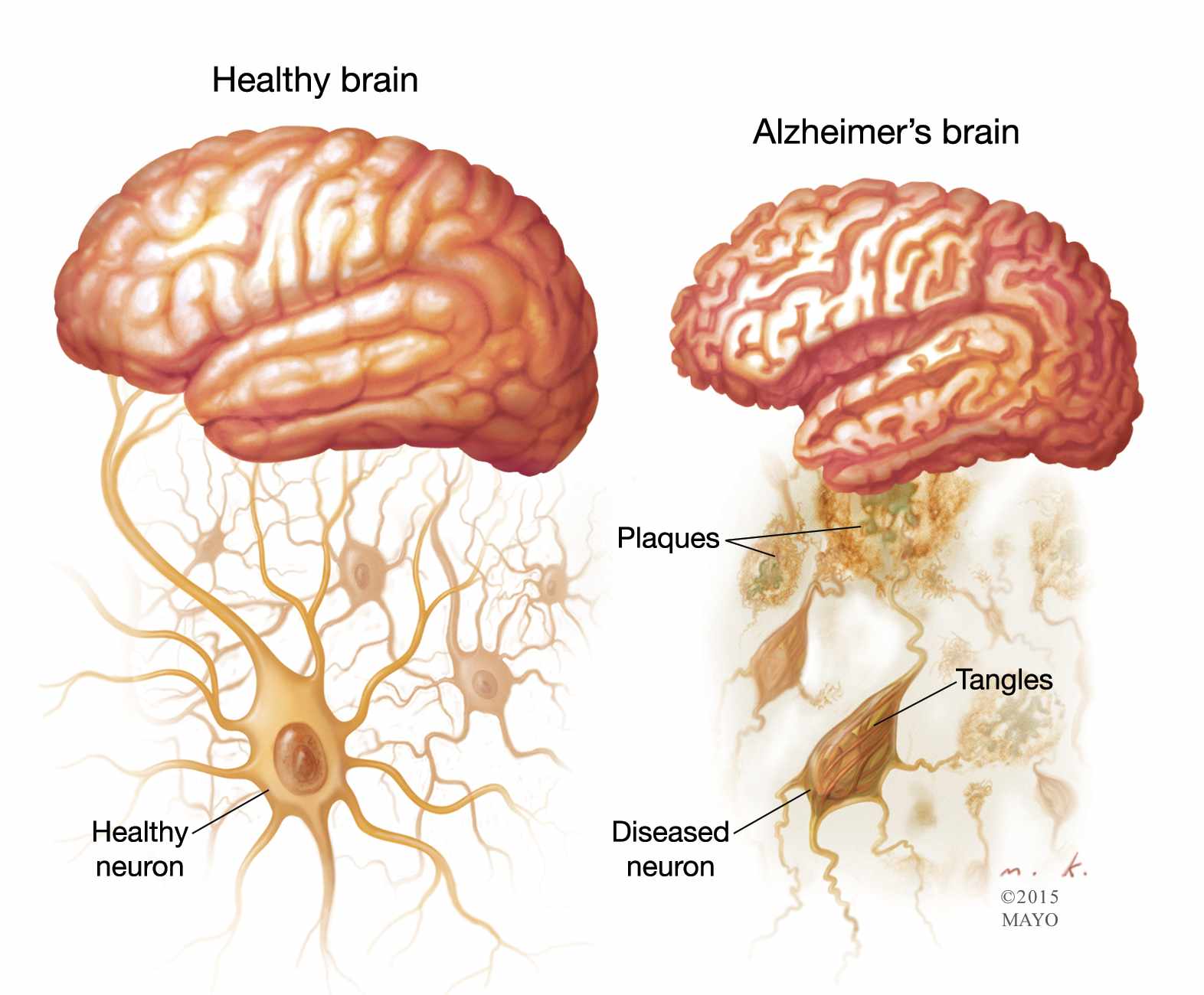 Alzheimers Brain Stages