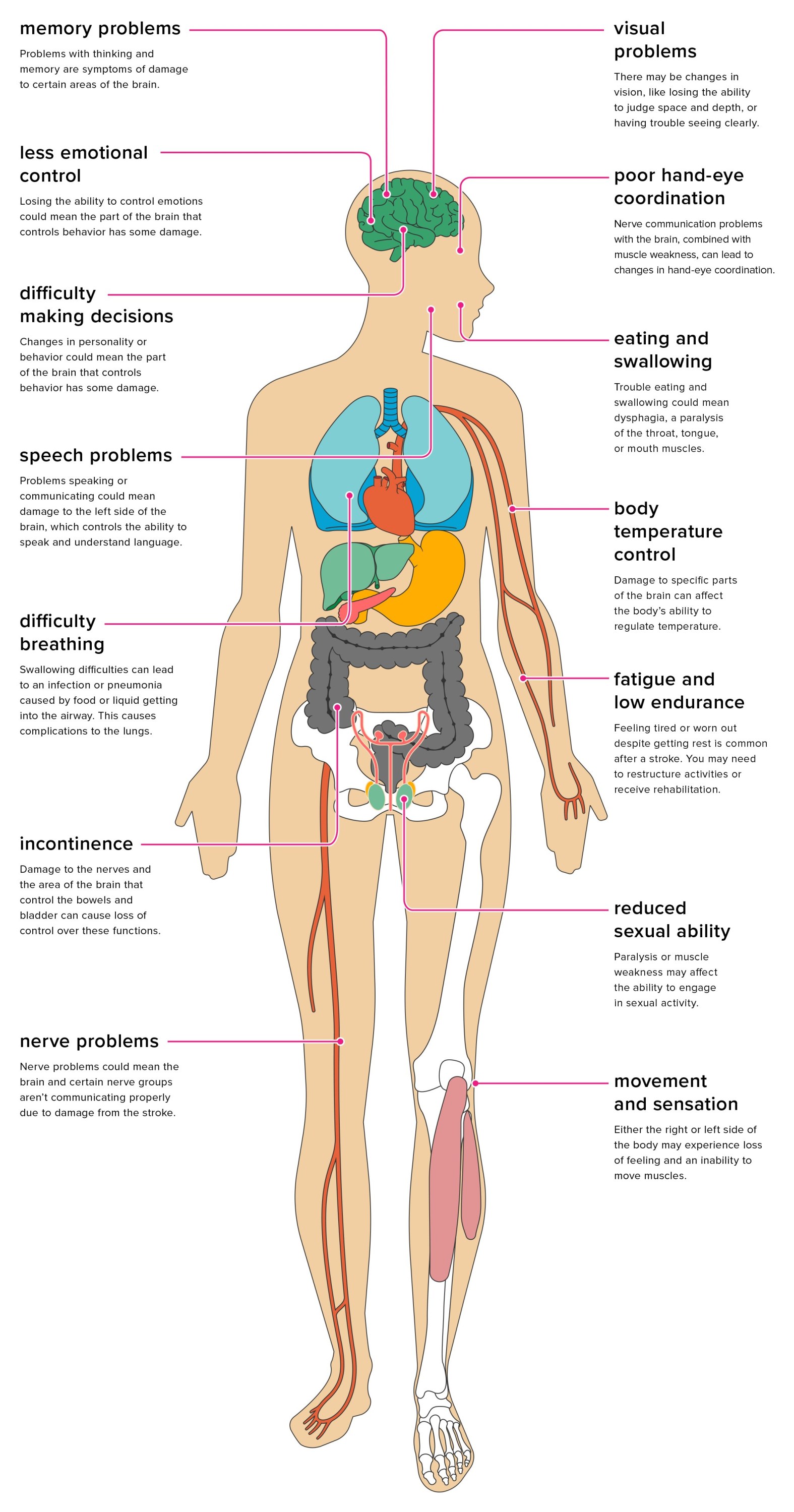 Stroke Rehabilitation