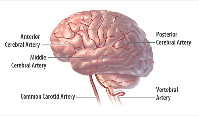 stroke brain artery